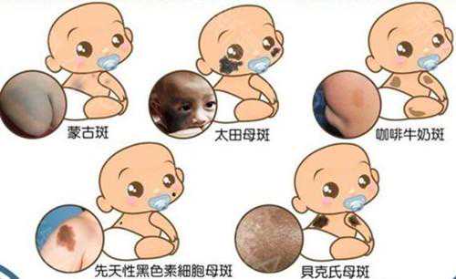 嬰幼兒各種胎記和斑痣解析大全，建議家長(zhǎng)收藏